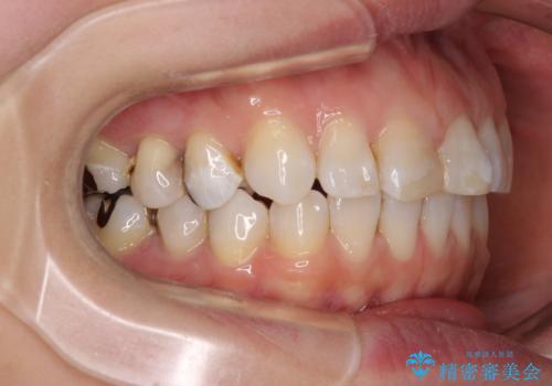 【モニター】前歯のデコボコを治したい インビザラインを用いた矯正治療の治療後