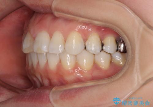 【モニター】前歯のデコボコを治したい インビザラインを用いた矯正治療の治療後