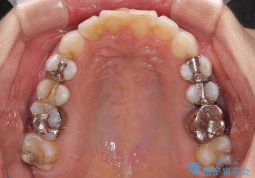 【モニター】前歯のデコボコを治したい インビザラインを用いた矯正治療の治療後