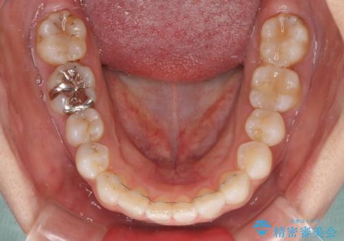 【モニター】前歯のデコボコを治したい インビザラインを用いた矯正治療の治療後