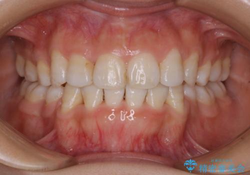 インビザライン単独での抜歯矯正治療の症例 治療後