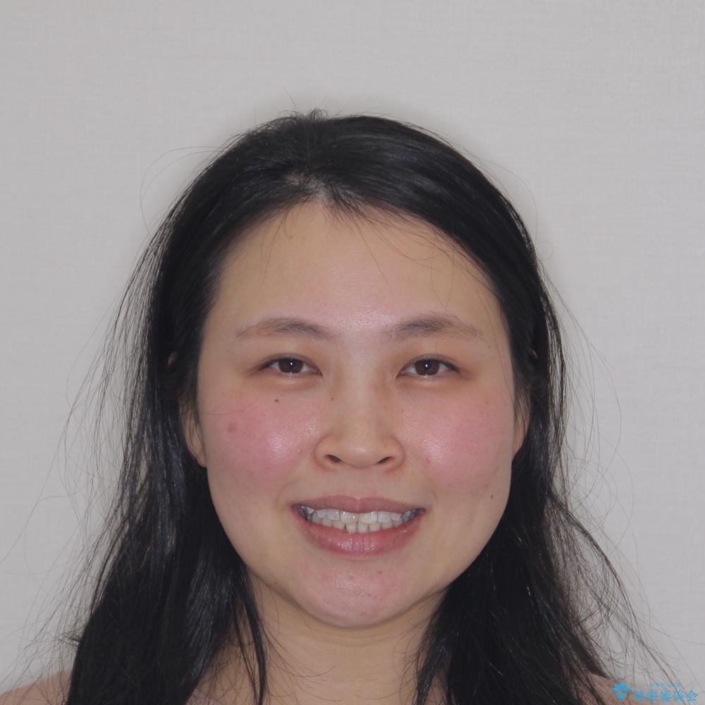 【モニター】前歯のデコボコを治したい インビザラインを用いた矯正治療の治療後(顔貌)