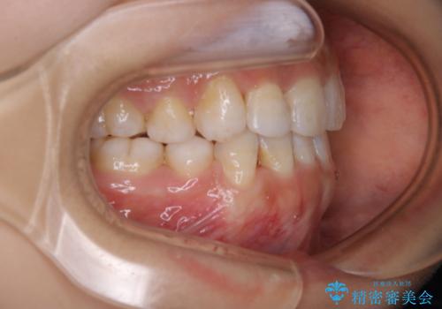 インビザライン単独での抜歯矯正治療の治療後