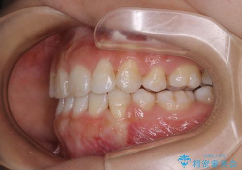 インビザライン単独での抜歯矯正治療の治療後