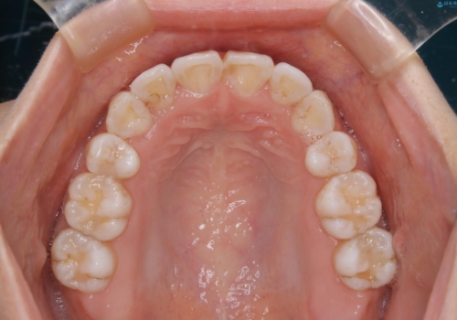 インビザライン単独での抜歯矯正治療の治療後