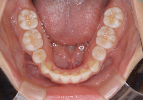 インビザライン単独での抜歯矯正治療の治療後