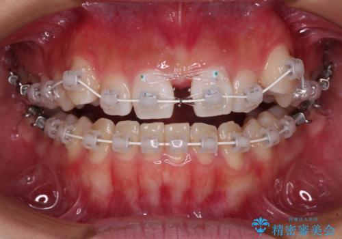 【モニター】上顎が狭い 急速拡大装置を用いたデコボコの解消の治療中