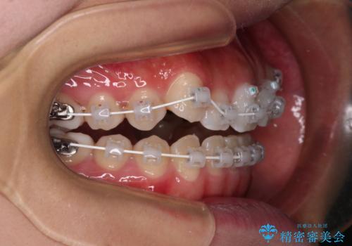 【モニター】上顎が狭い 急速拡大装置を用いたデコボコの解消の治療中