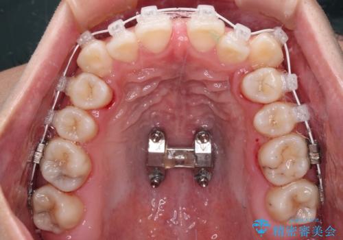 【モニター】上顎が狭い 急速拡大装置を用いたデコボコの解消の治療中