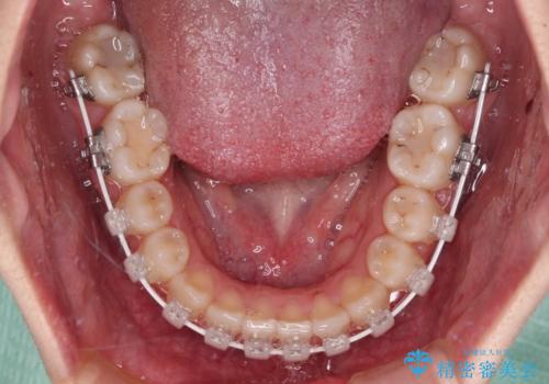 【モニター】上顎が狭い 急速拡大装置を用いたデコボコの解消の治療中