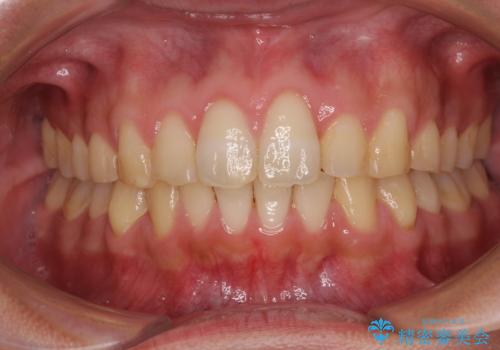 捻れて飛び出した前歯　インビザラインで整った前歯にの症例 治療後