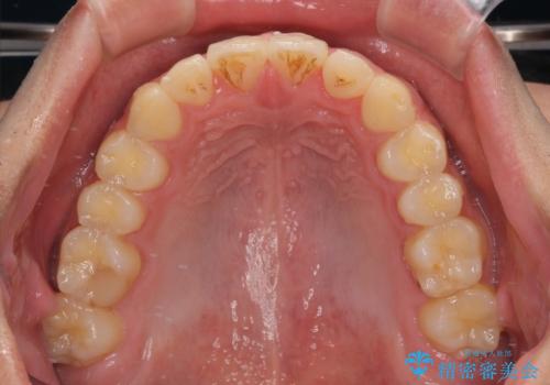 捻れて飛び出した前歯　インビザラインで整った前歯にの治療後