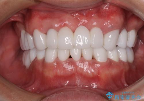 欠損と虫歯だらけの口の中　真っ白なセラミック治療の治療後