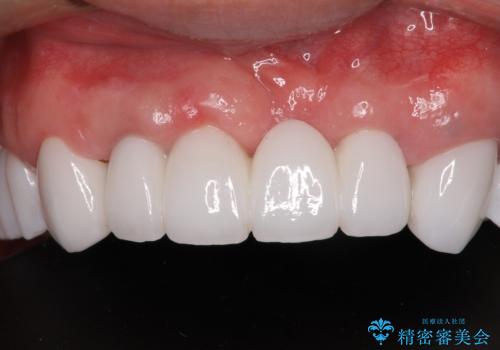 欠損と虫歯だらけの口の中　真っ白なセラミック治療の症例 治療後