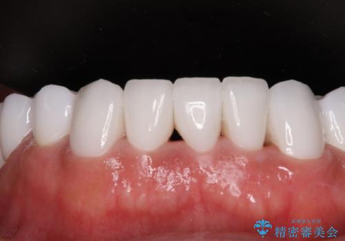 欠損と虫歯だらけの口の中 真っ白なセラミック治療の治療後