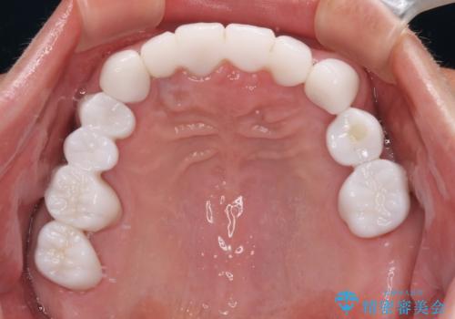 欠損と虫歯だらけの口の中　真っ白なセラミック治療の治療後
