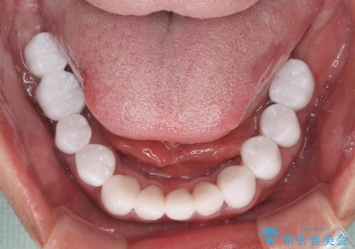 欠損と虫歯だらけの口の中 真っ白なセラミック治療の治療後