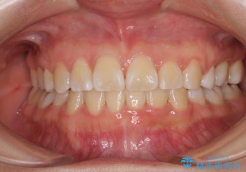 重度叢生と埋もれた奥歯 8本を抜歯したワイヤー矯正