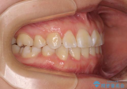 重度叢生と埋もれた奥歯 8本を抜歯したワイヤー矯正の治療後