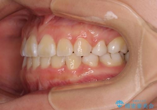重度叢生と埋もれた奥歯 8本を抜歯したワイヤー矯正の治療後