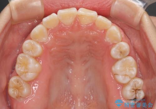 重度叢生と埋もれた奥歯 8本を抜歯したワイヤー矯正の治療後