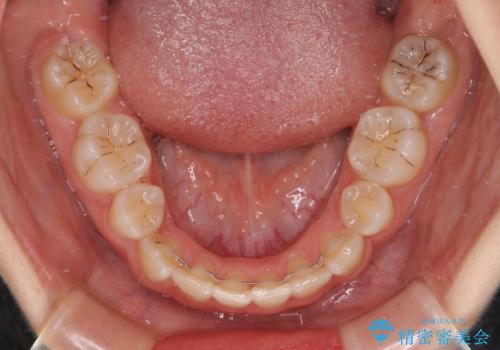 重度叢生と埋もれた奥歯 8本を抜歯したワイヤー矯正の治療後
