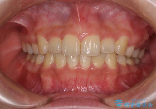 デコボコと膨らんだ口元 ハーフリンガルによる抜歯矯正とインプラント補綴治療