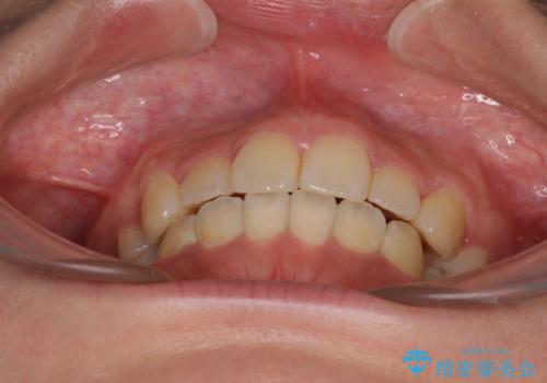 デコボコと膨らんだ口元　ハーフリンガルによる抜歯矯正とインプラント補綴治療の治療後