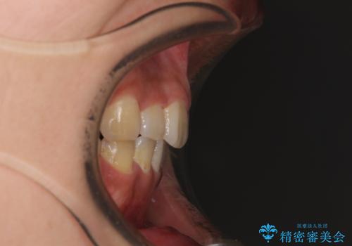 デコボコと膨らんだ口元 ハーフリンガルによる抜歯矯正とインプラント補綴治療の治療後