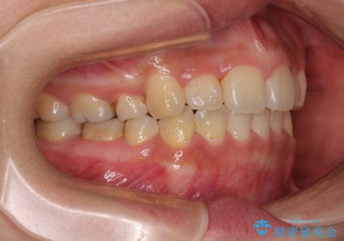 デコボコと膨らんだ口元 ハーフリンガルによる抜歯矯正とインプラント補綴治療の治療後