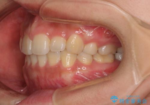 デコボコと膨らんだ口元 ハーフリンガルによる抜歯矯正とインプラント補綴治療の治療後