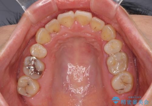 デコボコと膨らんだ口元 ハーフリンガルによる抜歯矯正とインプラント補綴治療の治療後