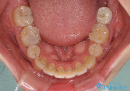 デコボコと膨らんだ口元 ハーフリンガルによる抜歯矯正とインプラント補綴治療の治療後