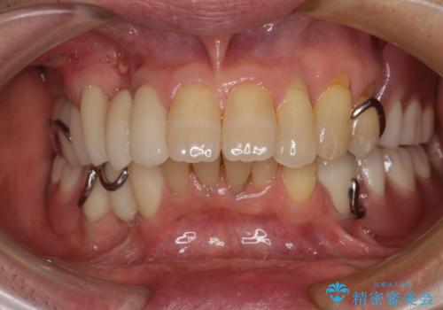 装着感の良い入れ歯を作りたい　金属床を使用した適合の良い部分床義歯の症例 治療後