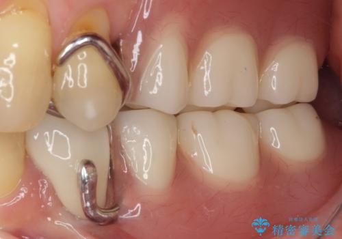 装着感の良い入れ歯を作りたい 金属床を使用した適合の良い部分床義歯の治療後