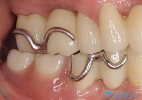 装着感の良い入れ歯を作りたい　金属床を使用した適合の良い部分床義歯の治療後