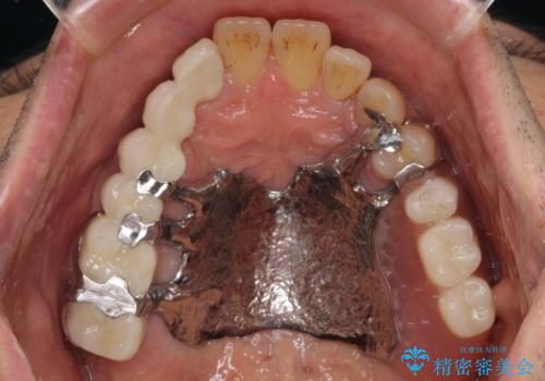 装着感の良い入れ歯を作りたい 金属床を使用した適合の良い部分床義歯の治療後
