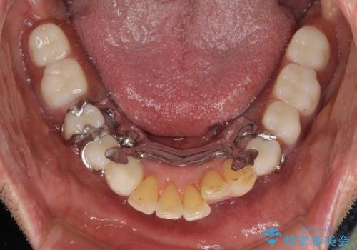 装着感の良い入れ歯を作りたい　金属床を使用した適合の良い部分床義歯の治療後