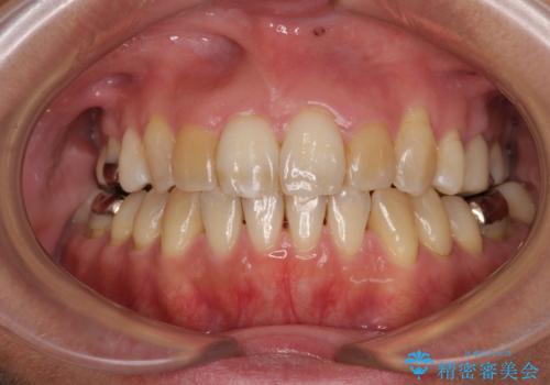 前歯の後戻り インビザラインでの再矯正治療の症例 治療後