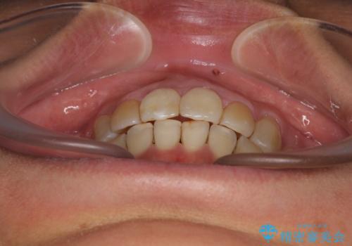 前歯の後戻り インビザラインでの再矯正治療の治療後