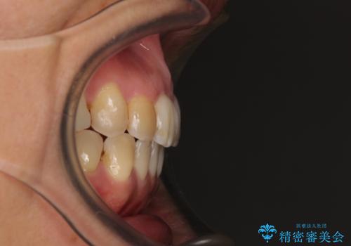 前歯の後戻り インビザラインでの再矯正治療の治療後