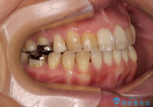 前歯の後戻り インビザラインでの再矯正治療の治療後