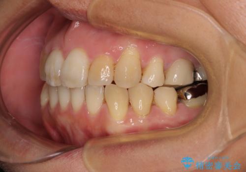 前歯の後戻り インビザラインでの再矯正治療の治療後