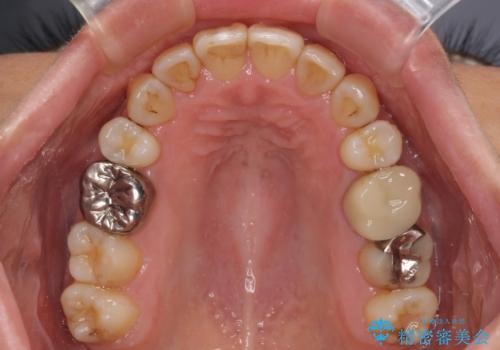 前歯の後戻り インビザラインでの再矯正治療の治療後