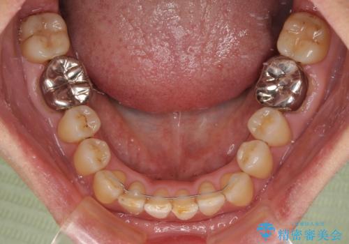 前歯の後戻り インビザラインでの再矯正治療の治療後
