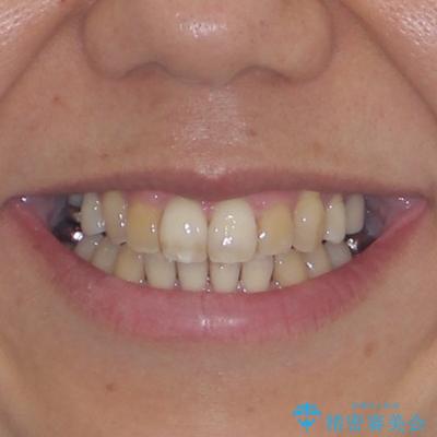 前歯の後戻り インビザラインでの再矯正治療の治療後(顔貌)