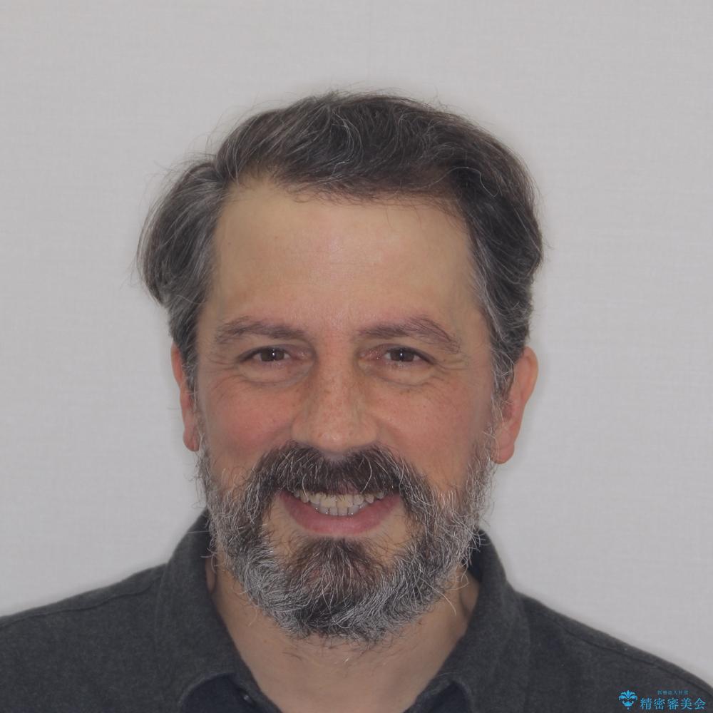 【モニター】前歯のデコボコを治したい インビザライン矯正治療の治療後(顔貌)