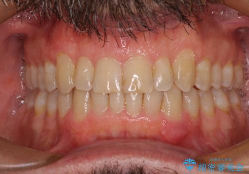 【モニター】前歯のデコボコを治したい インビザライン矯正治療の治療後