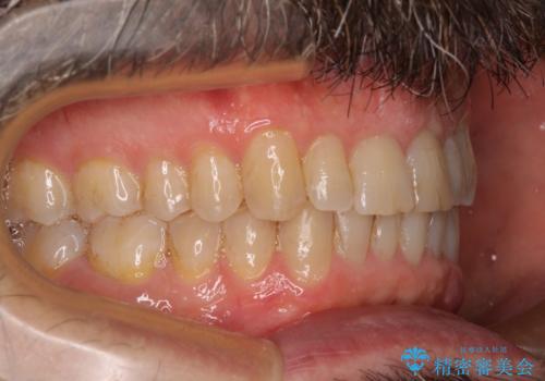 【モニター】前歯のデコボコを治したい インビザライン矯正治療の治療後