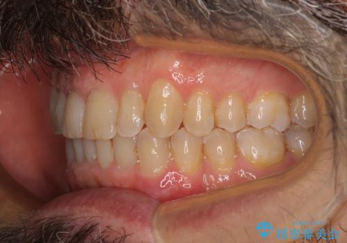 【モニター】前歯のデコボコを治したい インビザライン矯正治療の治療後